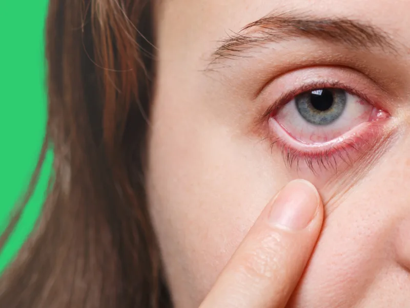 A Young White Girl Is Pulling Down The Lower Eyelid To Show Her Dry Eye A young white girl is pulling down the lower eyelid to show her dry eye