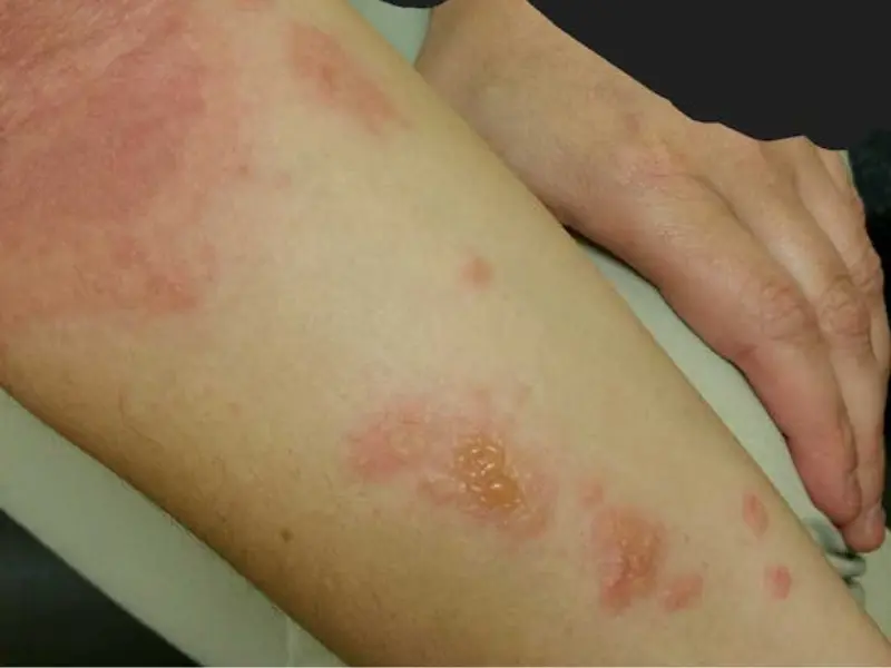 Arm Of A Person With Mango Rash Or Mango Dermititis Arm of a person with mango rash or mango dermititis.