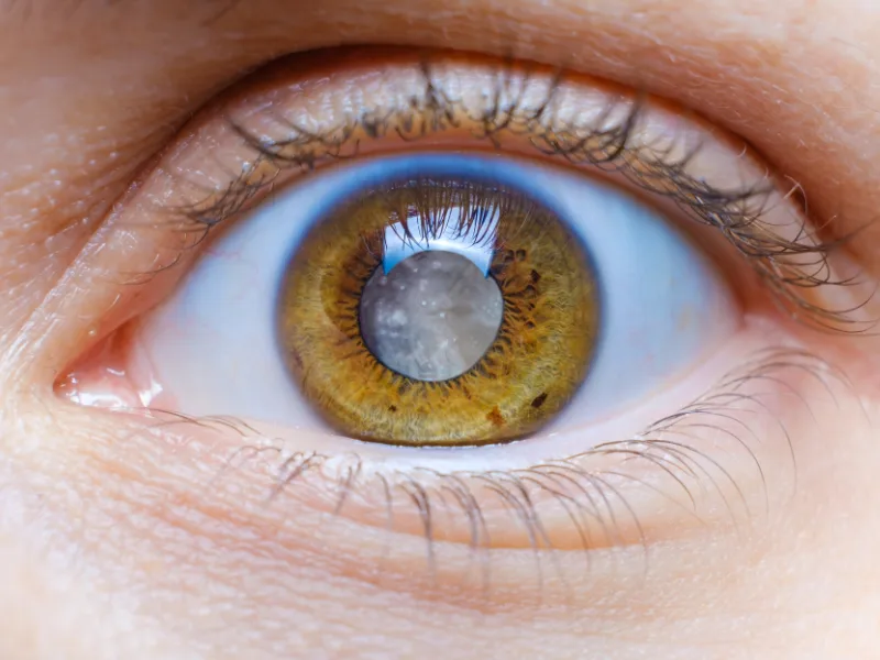 Cataracts