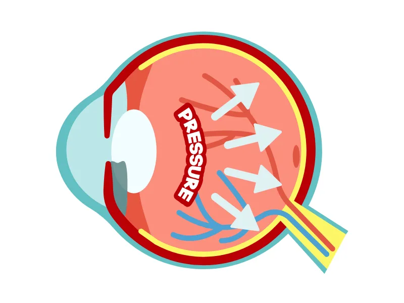 Glaucoma