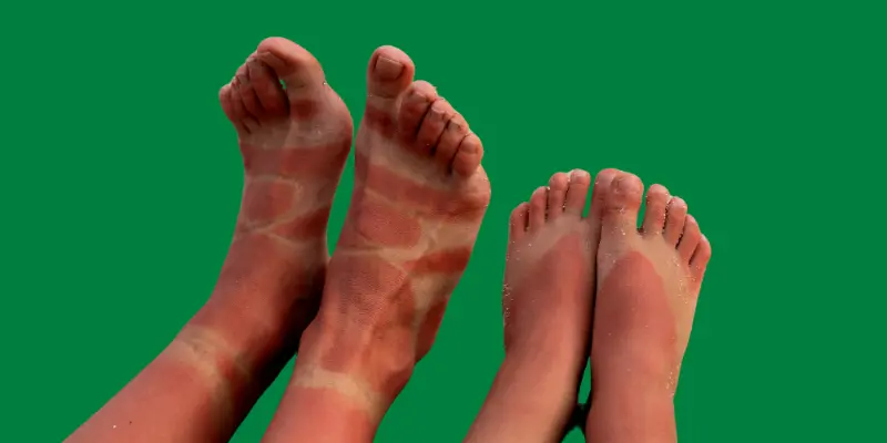 Feet of two persons having feet ulcers and wounds