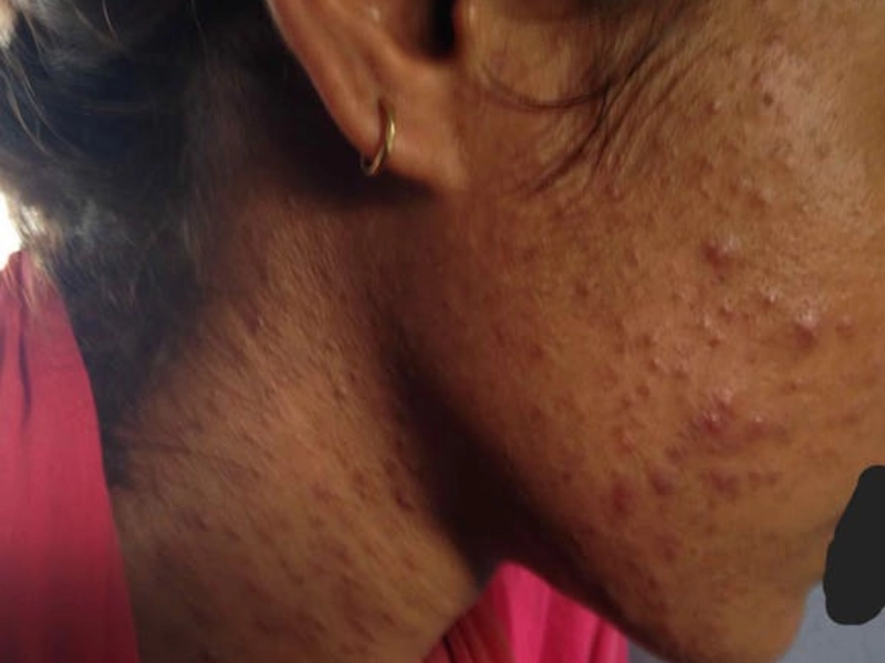 One side of face of young indian girl with acne on the face and neck.