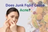 Does Junk Food Cause Acne? - Post Thumbnail