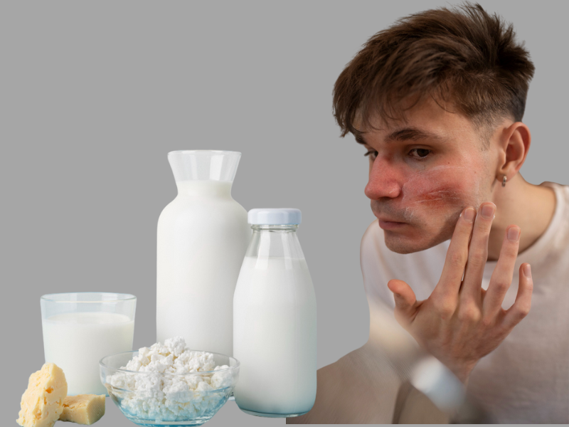 Young White Boy Pin Having Acne On His Face With Dairy Products Including Milk Cheese Is Placed Nearby Young white boy having acne on his face with dairy products including milk cheese is placed nearby
