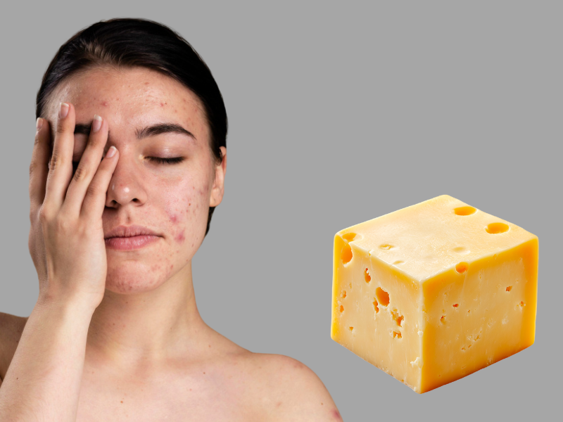 Young White Girl Having Acne On Her Face Hiding Her One Side Of Face And A Piece Of Cheese Is Placed Nearby Young white girl having acne on her face hiding her one side of face and a piece of cheese is placed nearby